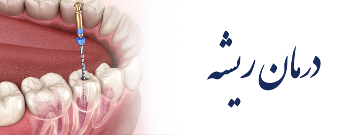 درمان ریشه درمان ریشه