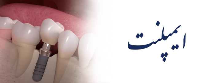 ایمپلنت ایمپلنت